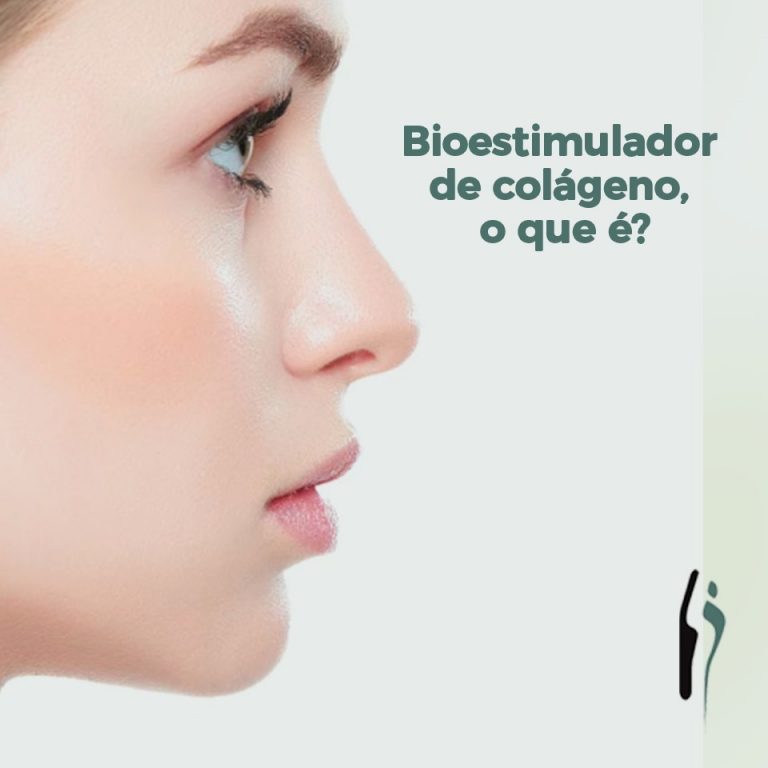 Bioestimuladores de Colágeno em Curitiba O que é, para quem é indicado, como funcionam