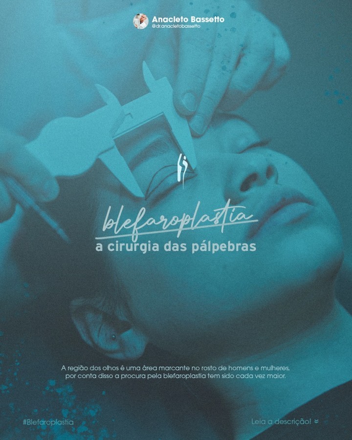 Blefaroplastia em Curitiba Conheça mais sobre a cirurgia plástica das pálpebras