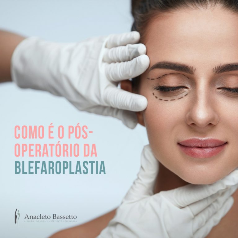 Blefaroplastia em Curitiba Dicas do pós-operatório da cirurgia