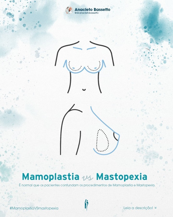 Cirurgia Plástica Curitiba Mamoplastia Vs Mastopexia