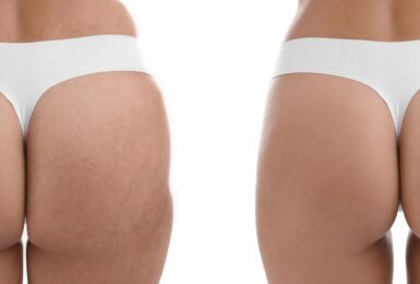 Gluteoplastia de Aumento