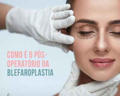 Blefaroplastia em Curitiba: Dicas do pós-operatório da cirurgia