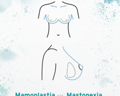 Cirurgia Plástica Curitiba: Mamoplastia Vs Mastopexia